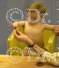 Patient before surgery of Triangle tilt, Mod quad , Brachial Plexus or Erbs palsy Surgery.