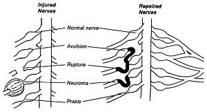 Nerve Graft Diagram, a nerve may be grafted if there is a rupture or avulsion. 
