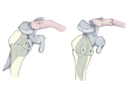 Mouse over on this picture to see next picture. Before and After Triangle tilt or Mod quad surgery pictures. Dr. Naths Book.