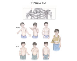 Mouse over on this picture to see next picture. Before and After Triangle tilt or Mod quad surgery pictures. Dr. Naths Book.