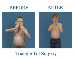 Mouse over on this picture to see next picture. Before and After Triangle tilt or Mod quad surgery pictures. Dr. Naths Book.