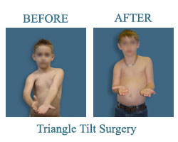 Mouse over on this picture to see next picture. Before and After Triangle tilt or Mod quad surgery pictures. Dr. Naths Book.