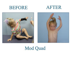 Mouse over on this picture to see next picture. Before and After Triangle tilt or Mod quad surgery pictures. Dr. Naths Book.