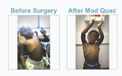Brachial Plexus photo gallery before and after pictures
