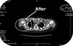 Brachial Plexus After CT images