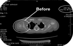Brachial Plexus Before CT images