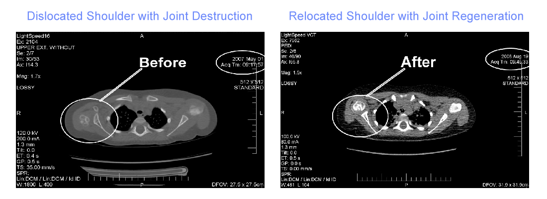 Brachial Plexus Before CT images