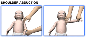 Brachial Plexus and erbs palsy - Baby Range of motion - Shoulder Abduction