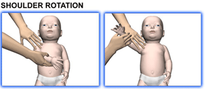 Brachial Plexus and erbs palsy - Baby Range of motion - Shoulder Rotation