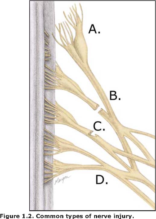 Common Type of Nerve Injury