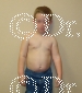 Before and After Triangle Tilt Surgery. Over a period of 12 Months. Hand at Rest