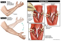 Biceps tendon lengthening