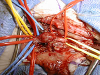 Brachial Plexus Rupture