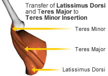 Mod Quad , Mod Quad surgery, Mod Quad operation, Modquad surgery , Mod-Quad Surgery, Transfer of Latissimus Dorsi and teres major to teres minor Insertion.