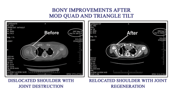 Bony Improvement - Before and After - Mod-Quad and TT